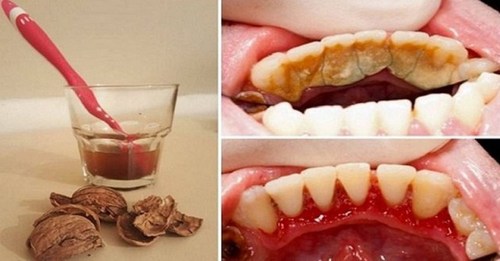 Как избавиться от зубного камня