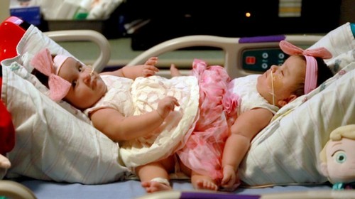 В США удачно разделили сиамских близнецов, сросшихся в области таза